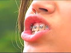 Zahnspangen Pornofilme, Gratis Sex XXX ohne Anmeldung